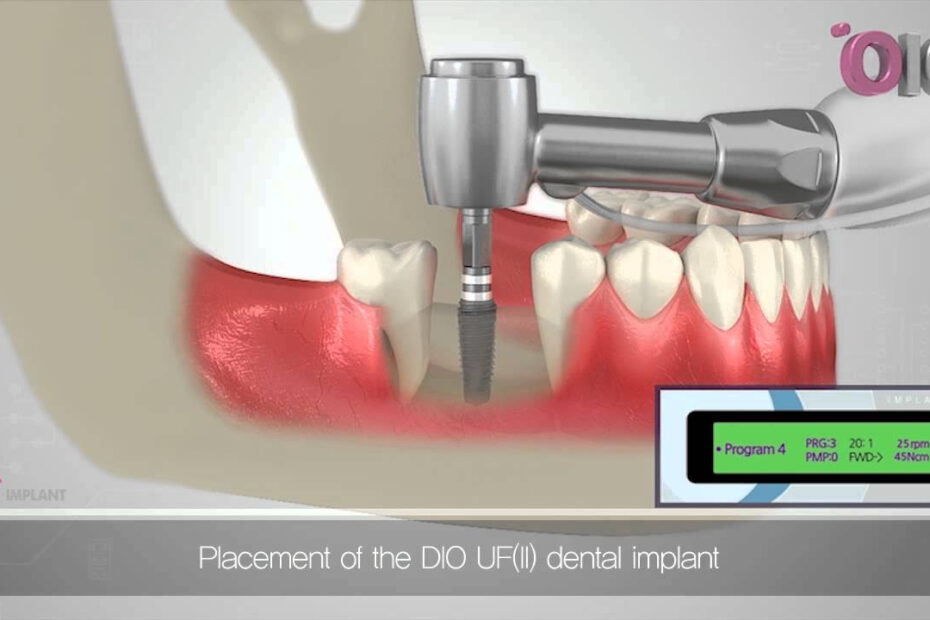How Does A Dental Implant Work