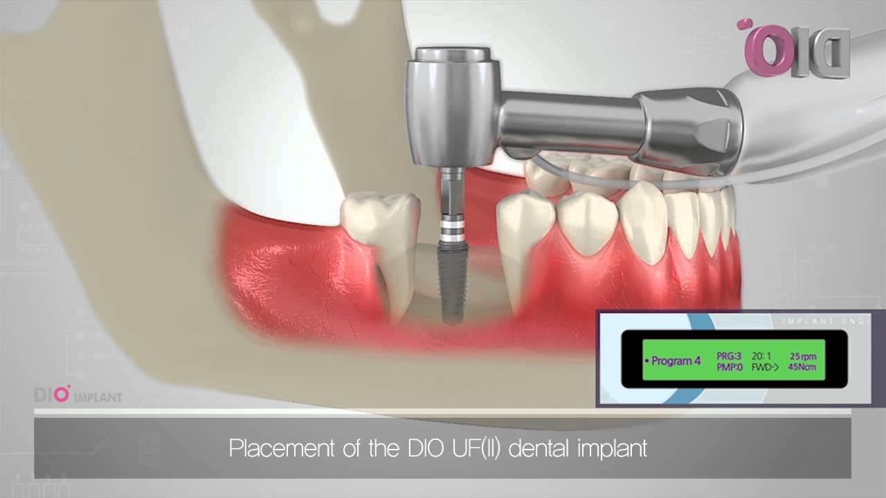 How Does A Dental Implant Work