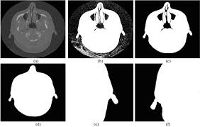 Hypopneumatisation Of The Mastoid Air Cells | Radiology Case |  Radiopaedia.Org