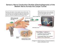 Salary: Nerve Conduction Technician (Jun, 2024) Us