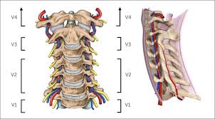 Tortuous Vertebral Artery | Radiology Case | Radiopaedia.Org