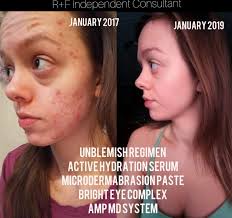 Before & After Acne Treatment Results | Rodan + Fields®