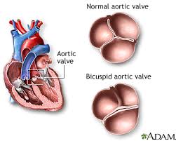 Mitral Valve - Wikipedia