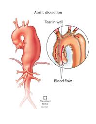 In-Hospital Mortality Aortic Dissection Type B. In-Hospital Mortality... |  Download Scientific Diagram